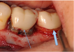 被せ物 クラウン を入れたあとに歯茎がはれている気がする 横浜の歯周病専門医 有楽歯科